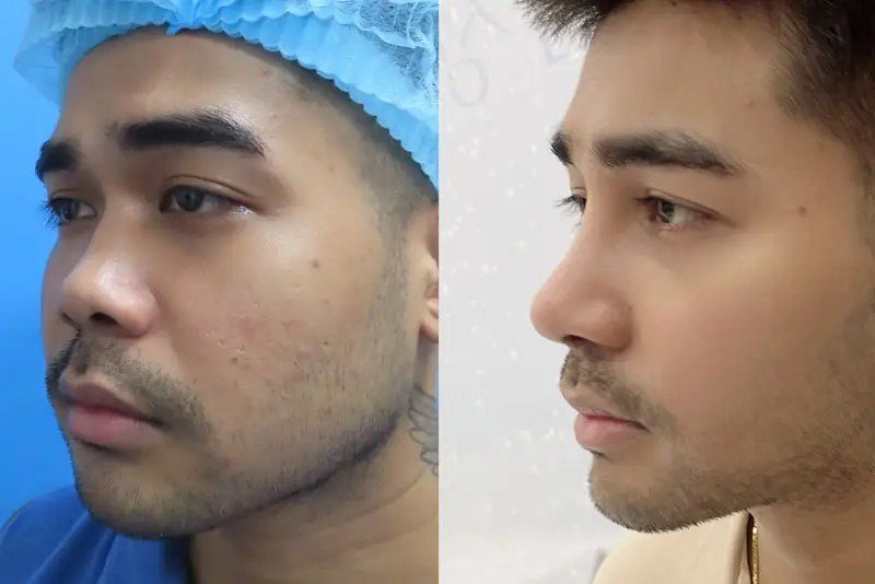 Nâng mũi L-line tăng vẻ nam tính