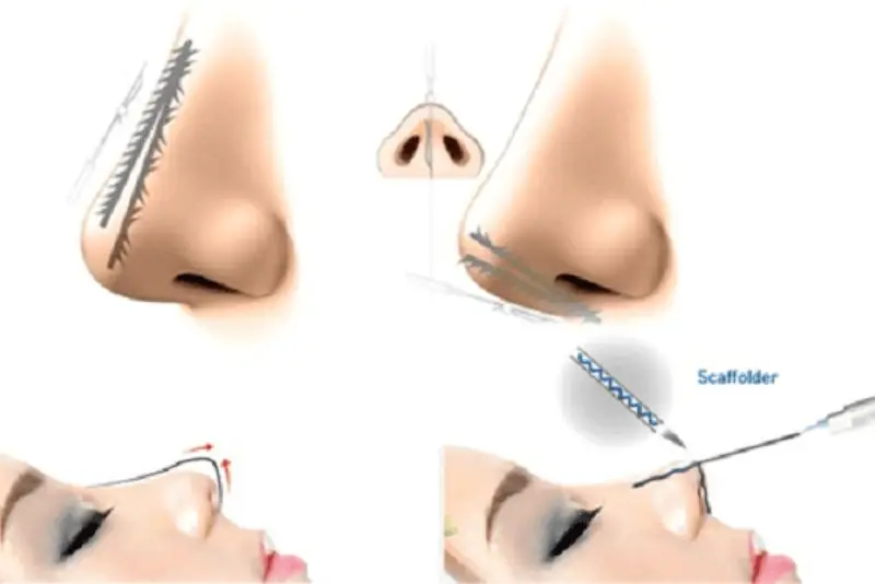 Nâng mũi bằng chỉ là phương pháp thẩm mỹ không phẫu thuật cắt rạch