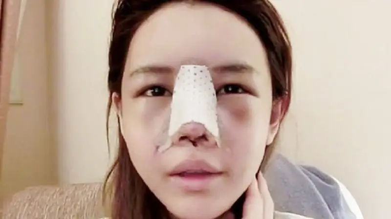 Trường hợp mũi hơi sưng tấy sau khi lỡ ăn thịt gà quá sớm