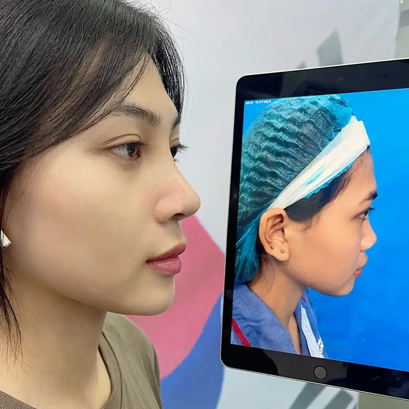 Nâng mũi cấu trúc giá dao động