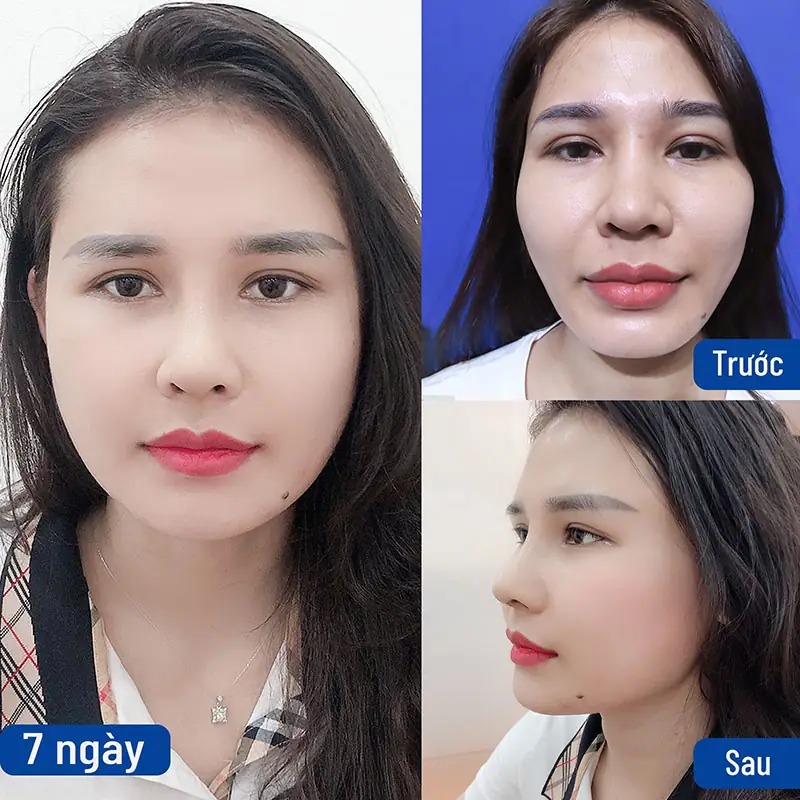 Khách hàng trước và sau khi sửa mũi