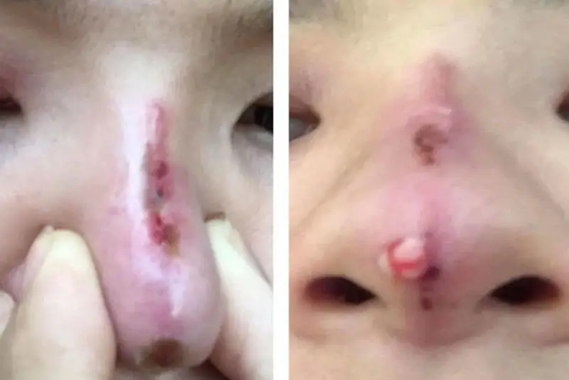 Biến chứng khi thực hiện tại cơ sở không an toàn