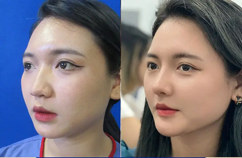 Kết quả nâng mũi duy trì lâu dài và ổn định