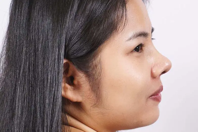 Đặt sụn sai vị trí khiến mũi không cao như mong muốn