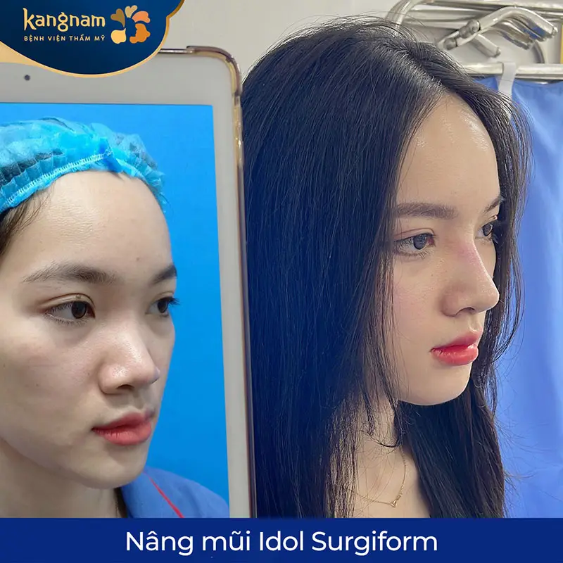 Dáng mũi cao, thon gọn giúp gương mặt hài hòa