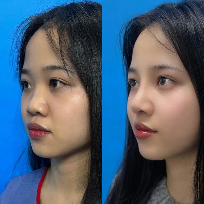 Đường nét mũi mềm mại, tự nhiên sau khi