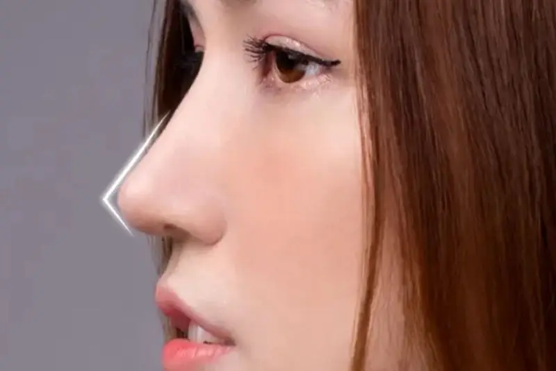 Nâng mũi L-Line là kỹ thuật tạo dáng mũi hình chữ L