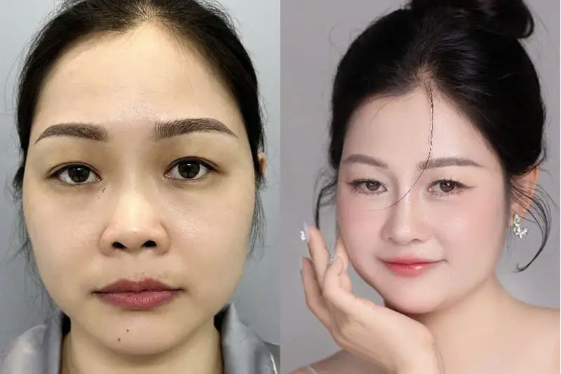 Thu nhỏ đầu mũi giúp gương mặt hài hòa hơn