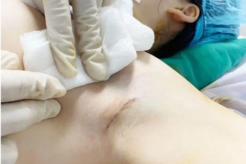 Nâng ngực đường nách giấu sẹo tốt nhất