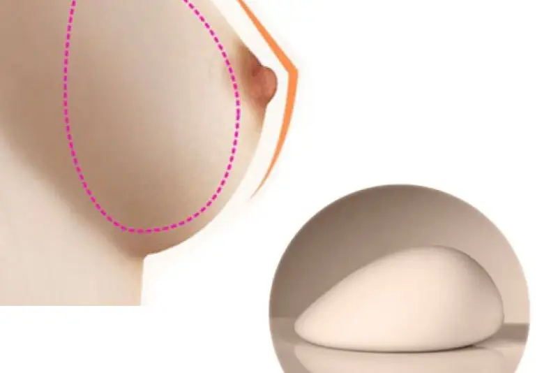 Nâng ngực giọt nước tạo dáng ngực tự nhiên