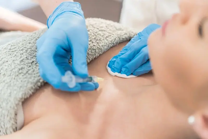 Tiêm filler ngực là phương pháp sử dụng chất làm đầy (thường là axit hyaluronic) tiêm trực tiếp vào mô ngực