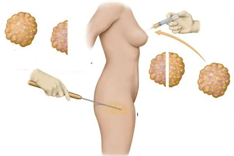 Nâng ngực không phẫu thuật