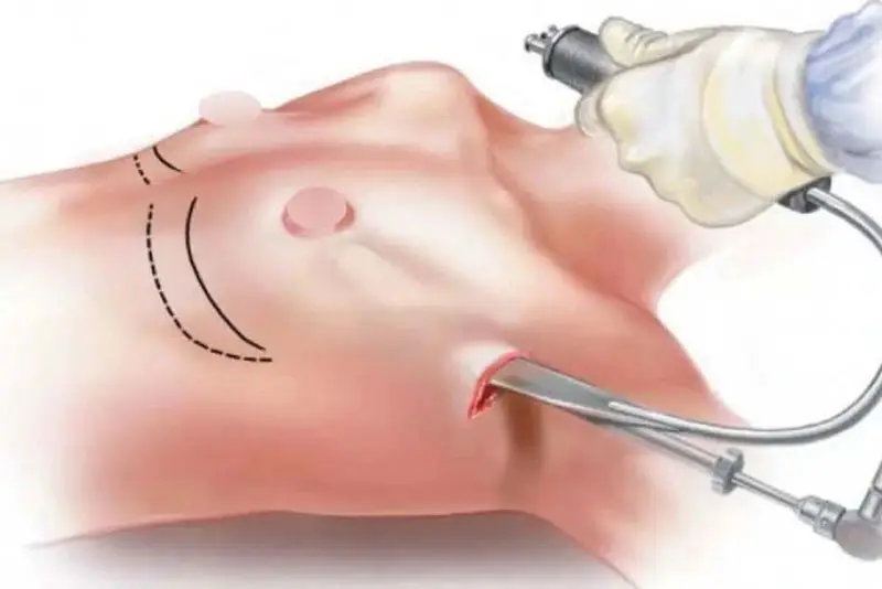 Nâng ngực nội soi giảm thiểu xâm lấn, nhanh hồi phục