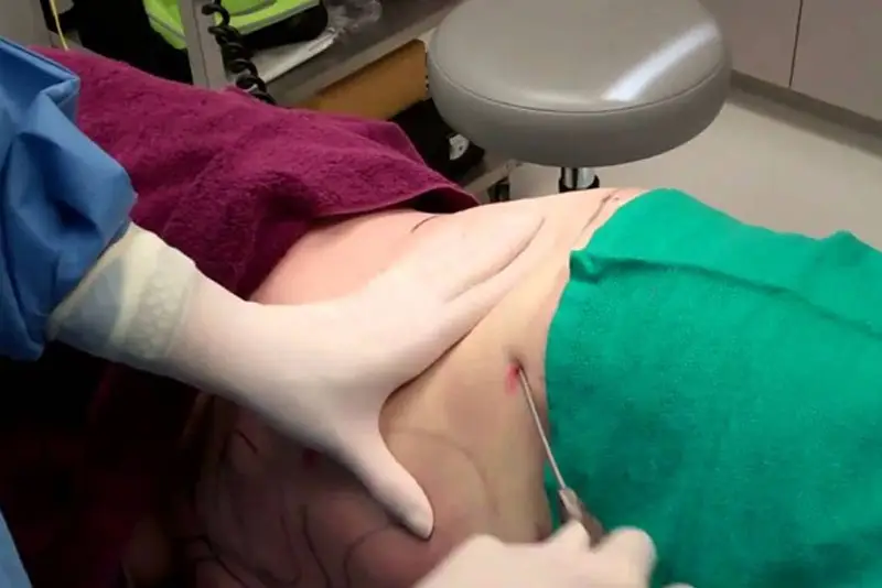 Nâng ngực bằng mỡ tự thân có thể tiềm ẩn biến chứng như: tiêu mỡ không đều, vón cục, nhiễm trùng, sẹo xấu, tụ dịch, chảy máu