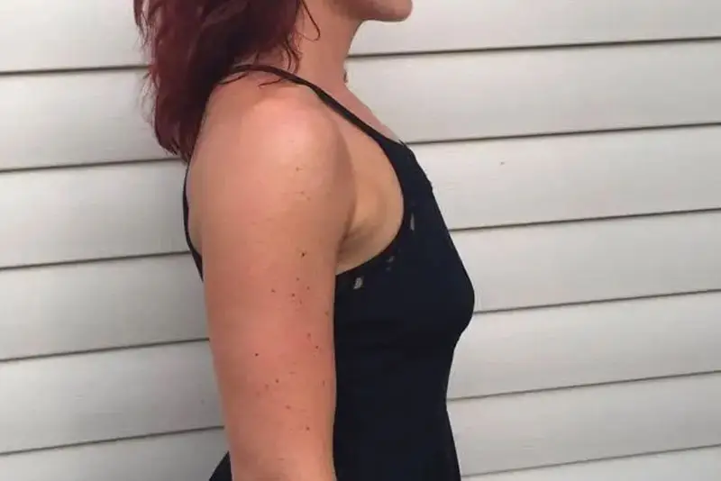 Vòng 1 lép ảnh hưởng đến tính thẩm mỹ