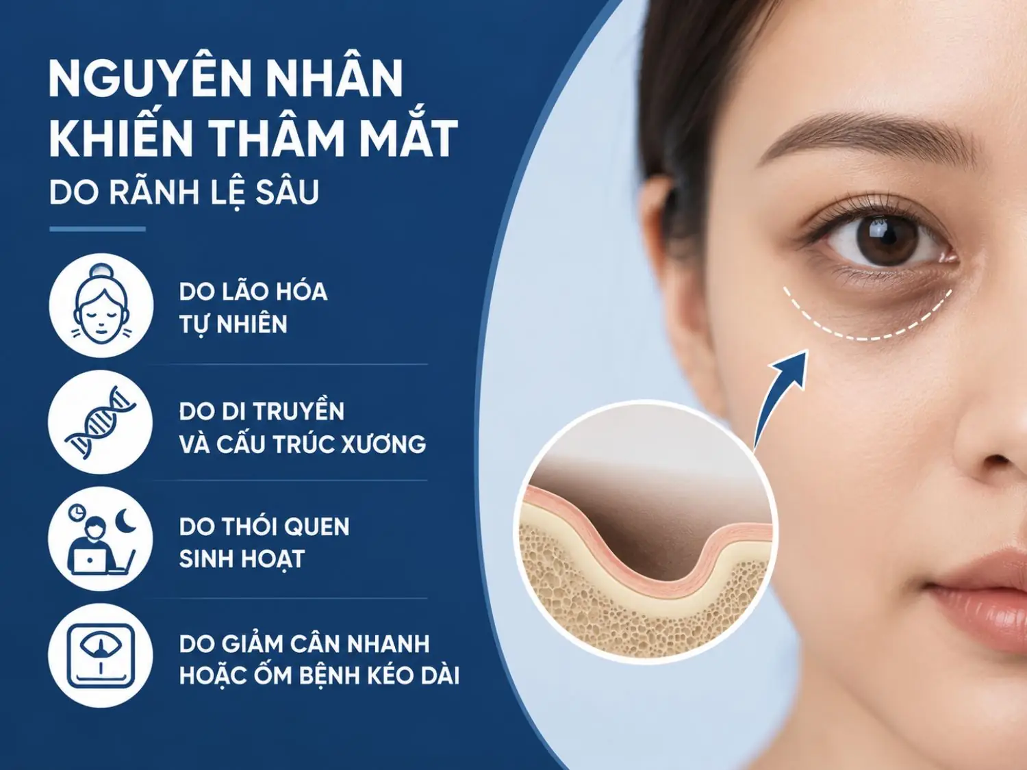 Rãnh lệ sâu khiến vùng dưới mắt dễ xuất hiện quầng thâm và hốc mắt mệt mỏi. Tình trạng này thường liên quan đến lão hóa, cấu trúc xương, thói quen sinh hoạt hoặc sụt cân kéo dài.
