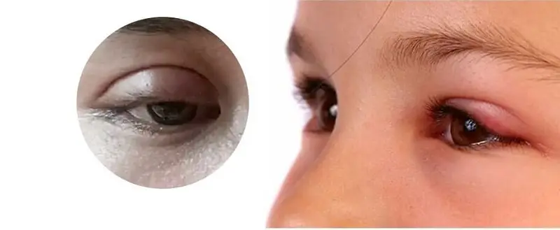 Sau khi vừa nhấn mí vết thương sẽ xuất hiện triệu chứng sưng tấy