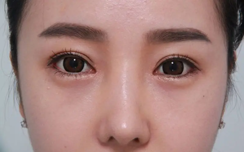 Sau khoảng 7 ngày mí mắt đã hết sưng và ổn định hơn