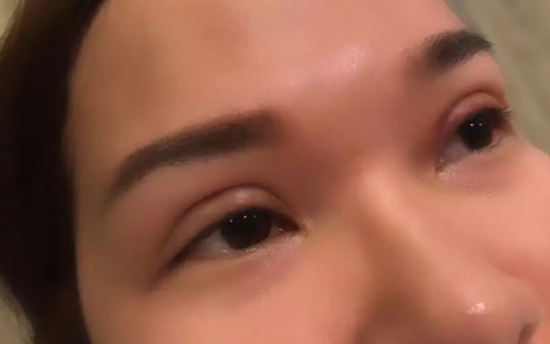 Vết thương sau nhấn mí mắt sẽ lành sau vài ngày