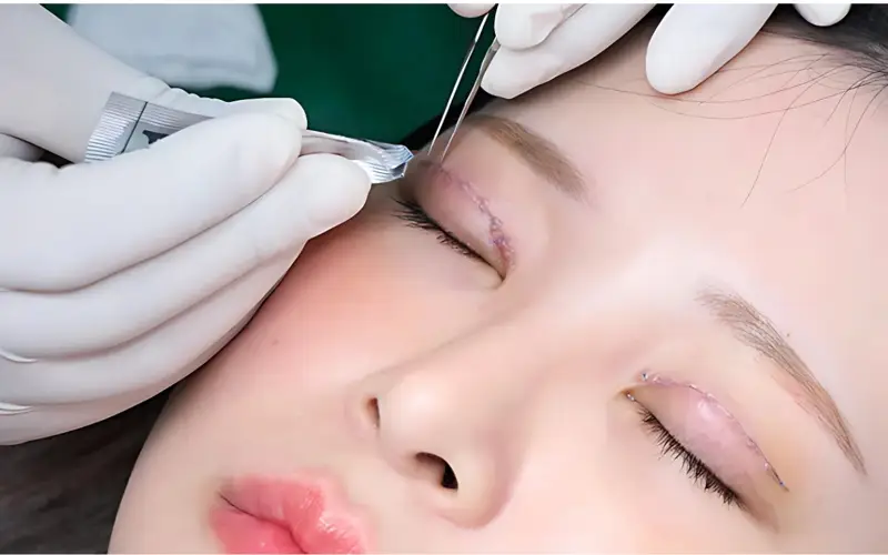 Nhấn mí có cần cắt chỉ không?  