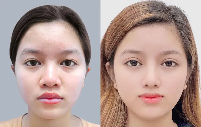 Khách hàng sở hữu đôi mắt to tròn, tự nhiên sau khi bấm mí