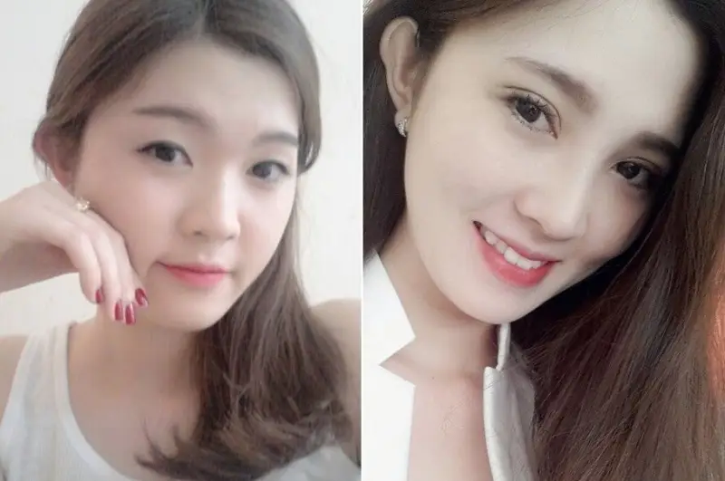 Nhấn mí tại Kangnam giúp khách hàng sở hữu nếp mí cân đối