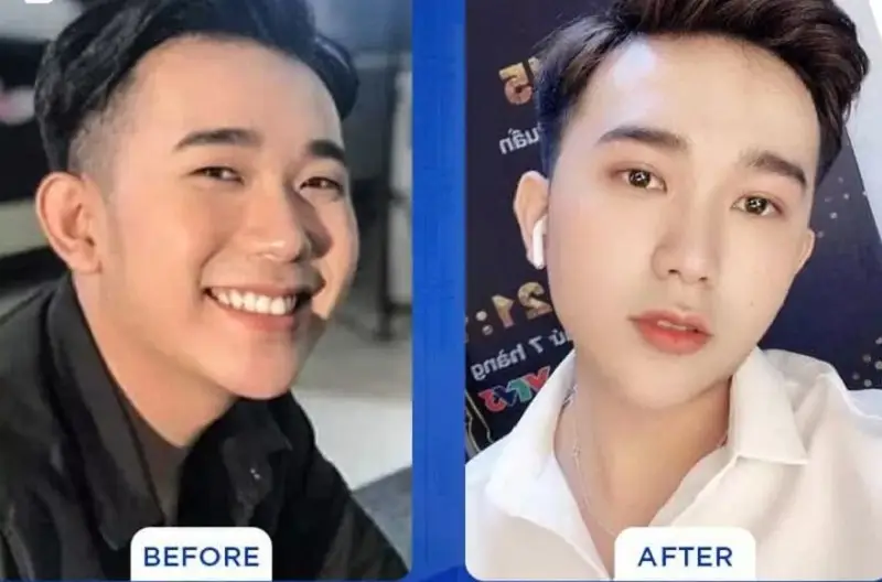 Nhấn mí mắt giúp khách hàng sở hữu đôi mắt đẹp tự nhiên, không cần phẫu thuật