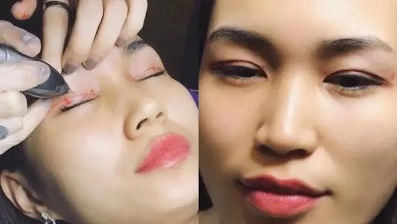 Nhấn mí bằng máy Plasma không xấm lấn, thời gian phục hồi nhanh