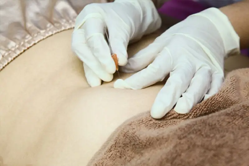Phác đồ cấy chỉ mỡ bụng sử dụng kim để châm cứu vào các huyệt đạo