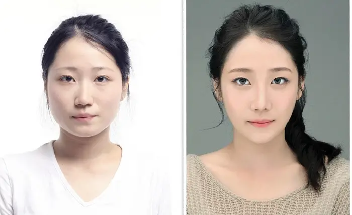 Khuôn mặt thon gọn hơn sau khi gọt hàm 