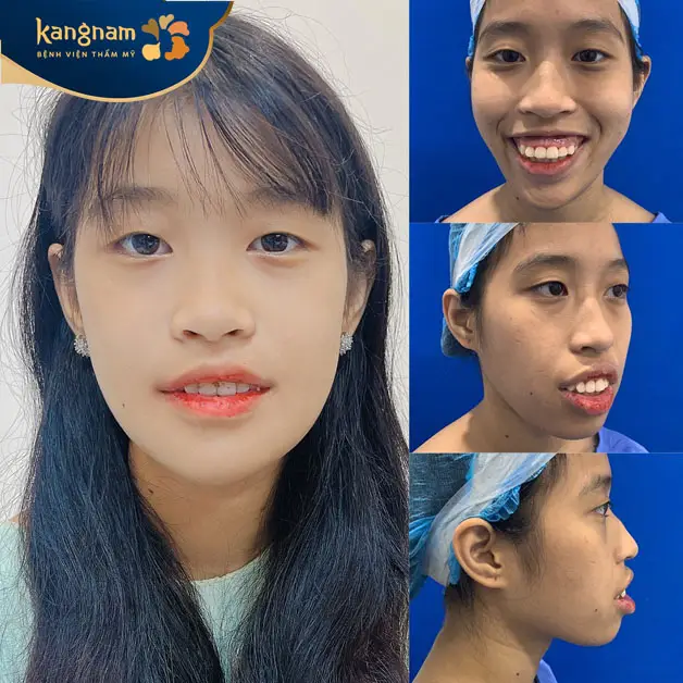 Chỉnh hàm chữa cười hở lợi hiệu quả