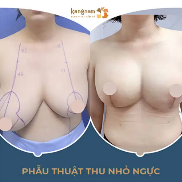 Hình ảnh so sánh trước và sau khi thu nhỏ ngực, thể hiện rõ sự thay đổi về kích thước và hình dáng ngực
