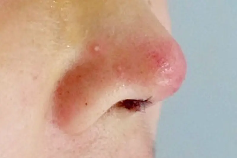 Quan hệ tình dục quá mạnh bạo có thể vô tình tác động vào mũi, khiến mũi sưng đỏ