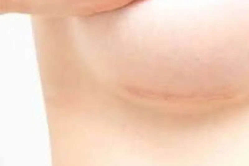 Thoa kem trị sẹo đều đặn giúp sẹo mờ nhanh