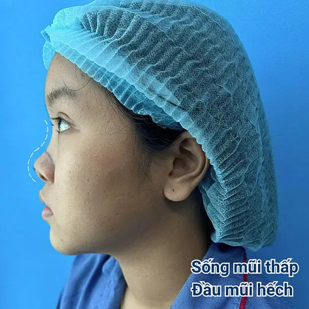 Mũi nhiều khuyết điểm không phù hợp nâng mũi bằng chỉ