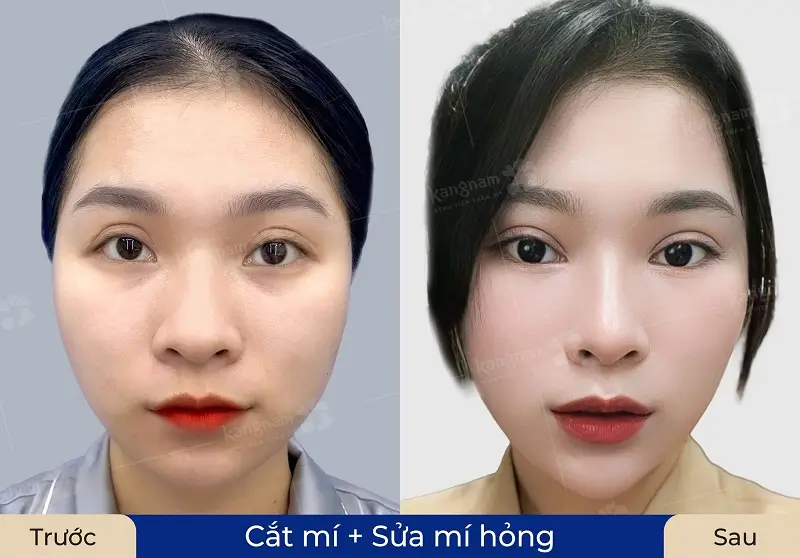 Khách hàng sở hữu đôi mắt to tròn, cân đối sau khi sửa lại mí trợn