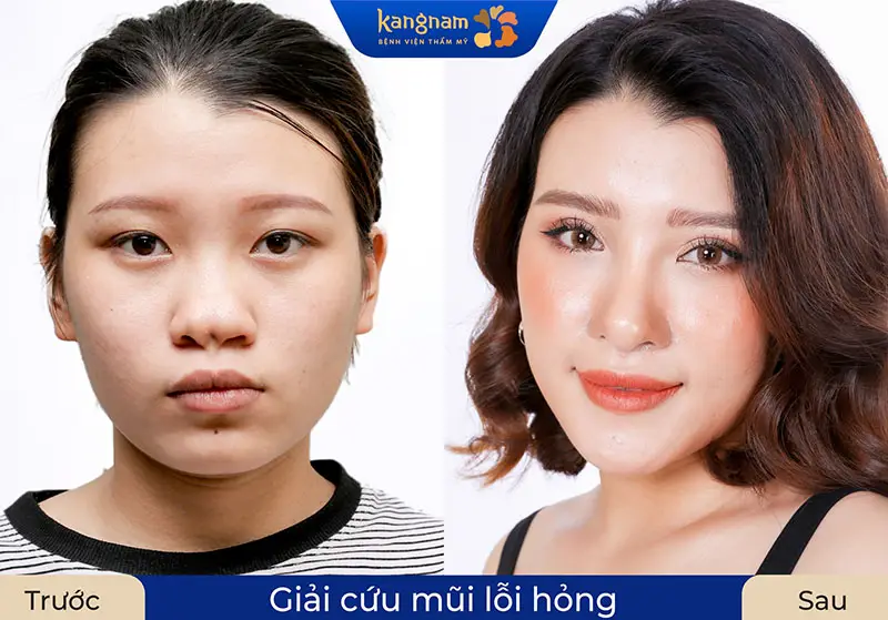 Sữa mũi hỏng chi phí cao hơn nâng mũi lần đầu