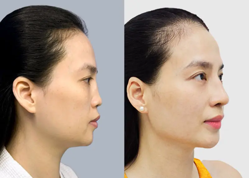 Sống mũi thẳng và cân đối hơn sau khi chỉnh sửa