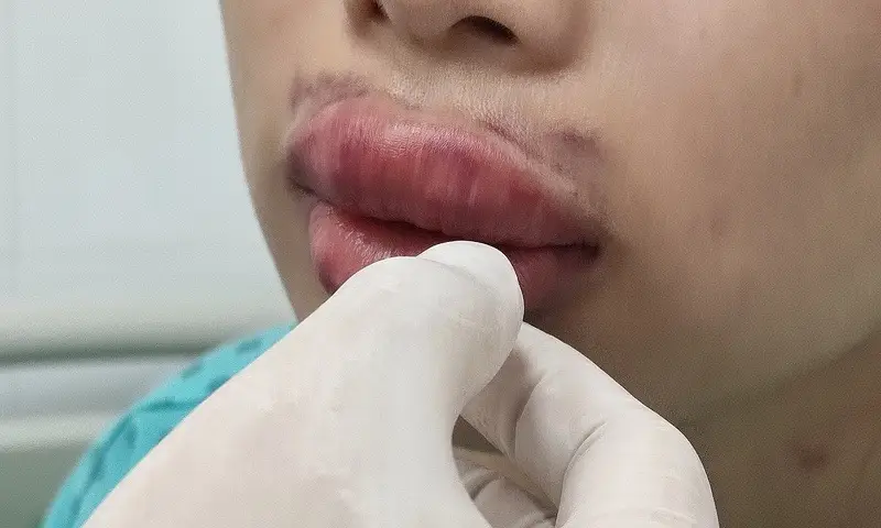 Trường hợp kỹ thuật cấy mỡ môi không chính xác có thể gây hoại tử