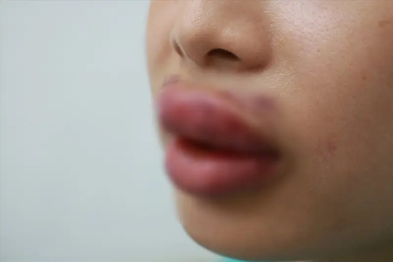 Môi bị biến dạng nặng nề nếu cấy mỡ không an toàn