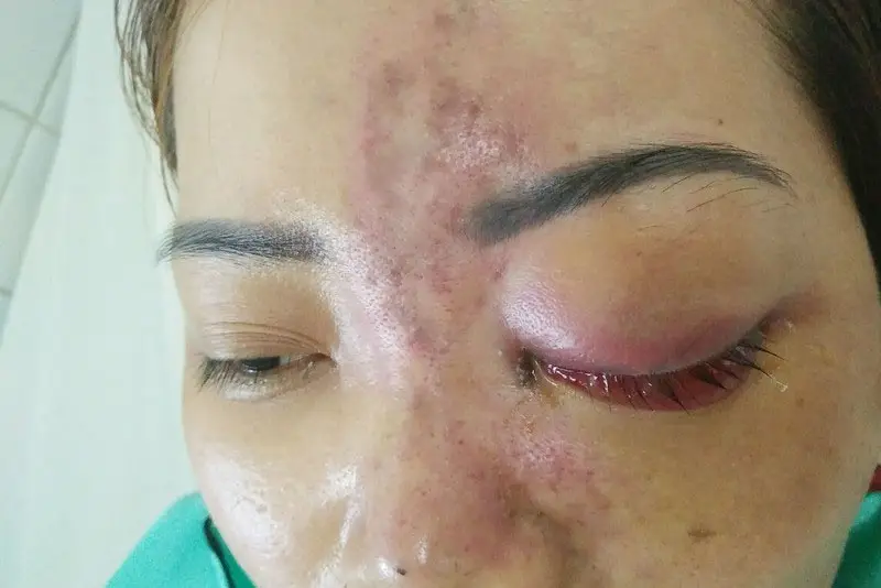 Mù mắt do tiêm filler không đúng cách