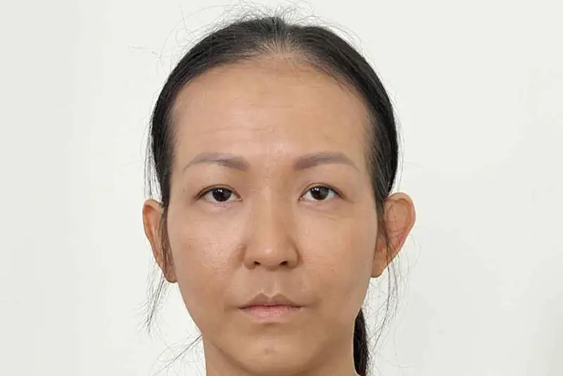 Thái dương hóp khiến gương mặt già nua có thể cân nhắc tiêm filler