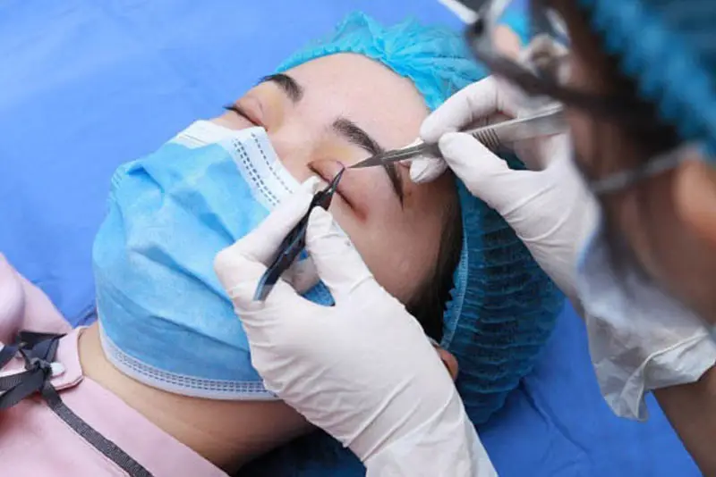 Quá trình tháo chỉ sau cắt mí nhẹ nhàng