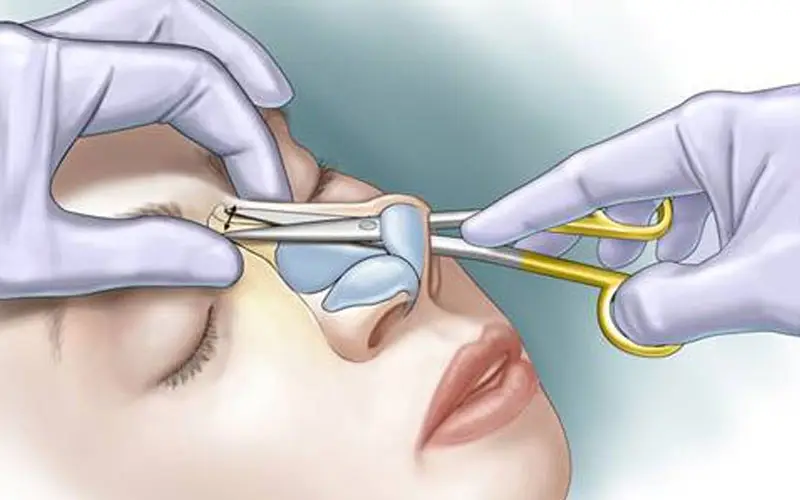 Tháo sụn mũi để tránh mũi viêm, nhiễm, biến chứng nặng hơn