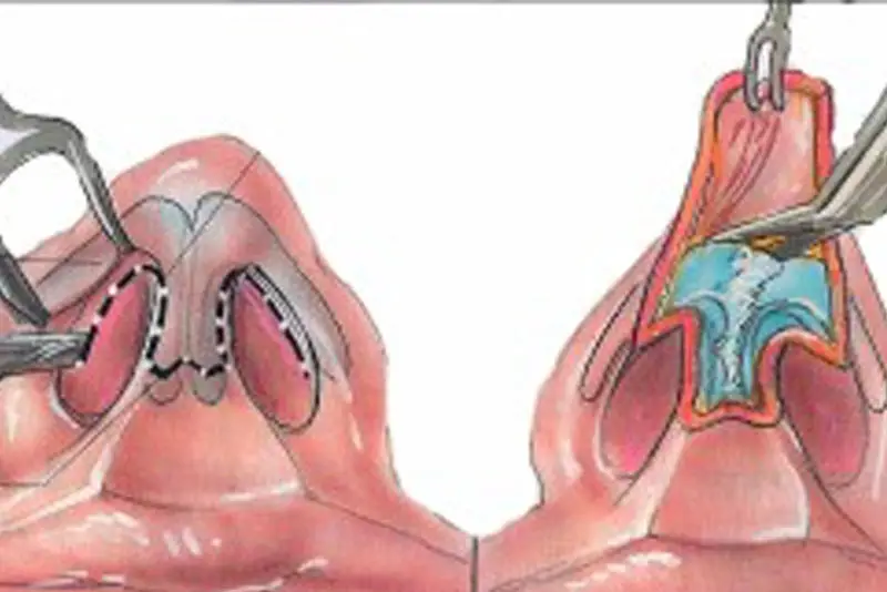 Mô phỏng quá trình thu nhỏ đầu mũi