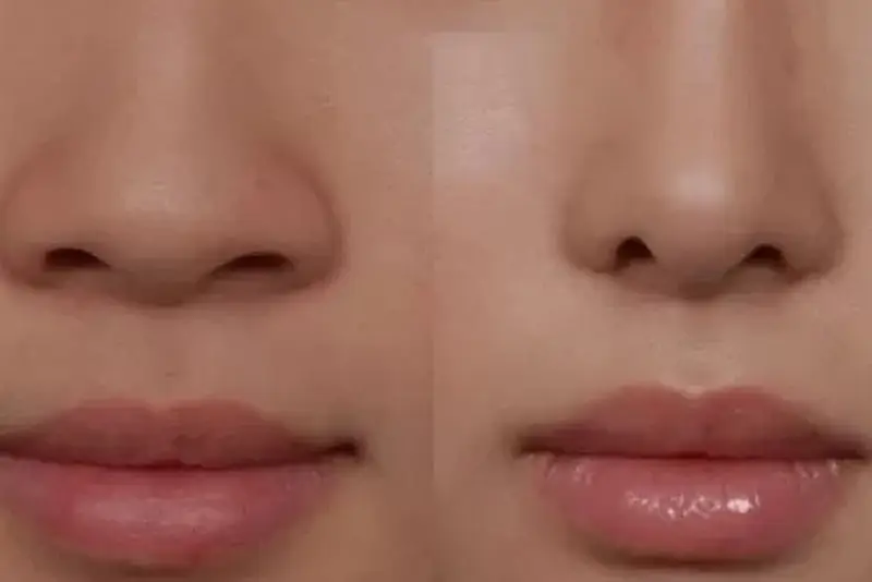 Nếu kỹ thuật phẫu thuật tốt thì dáng mũi sẽ ổn định sau nhiều năm