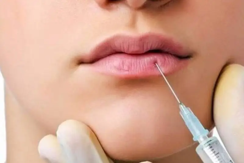 Tiêm filler môi không hài lòng có thể tìm đến giải pháp tiêm tan