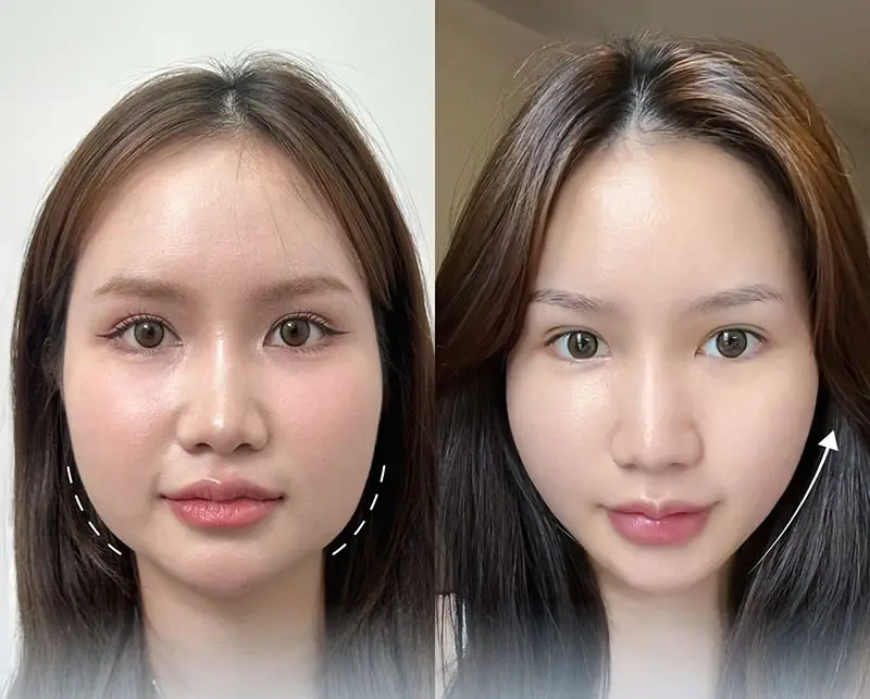 Sau tiêm botox gọn hàm khách hàng sở hữu khuôn mặt thon gọn, cân đối