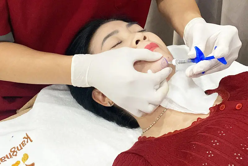Tiêm filler cằm là phương pháp không phẫu thuật, tạo dáng cằm dài và thon hơn
