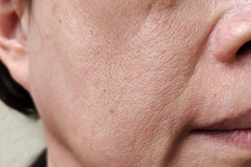 Filler không phải nguyên nhân gây chảy xệ da